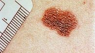 ChatGPT podría identificar si tienes cáncer de piel: comparte una foto de su mano y le advierte de un melanoma lentiginoso acral