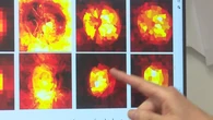 Un novedoso estudio detecta glaucoma con Inteligencia Artificial
