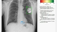 Una IA ajusta la resonancia magnética al marcapasos del paciente para garantizar su seguridad