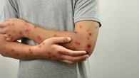 Sanidad recomienda más vacunación por el repunte mundial de sarampión