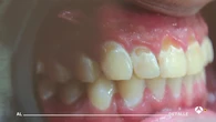Los dentistas alertan de los efectos de vapear en la salud bucodental