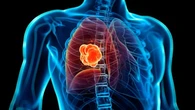 Una investigación logra frenar las recaídas de cáncer tras la cirugía en tumores de pulmón iniciales