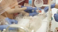 Una placenta artificial logra mantener con vida durante 21 días a un feto prematuro en un ensayo pionero en Europa