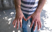 Mpox Cases Spike In Liberia
