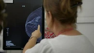 Routine breast cancer test could be used to screen heart disease
