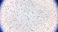Sperm donor with rare genetic mutation fathered 67 children. Ten have cancer