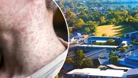 Measles alert issued after confirmed case at primary school