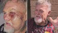 Perth grandfather needed metal plates in face after alleged bashing