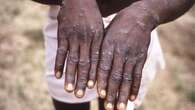 Argentina cargo ship crew member shows symptoms of mpox