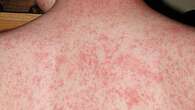 Health warning after measles case identified in Perth