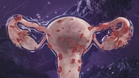 'It never stops': New drug to treat endometriosis after decade of pain