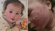 Nikki's baby had a common rash. She says withdrawal from the treatment was even worse