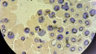 Hidden risks of 'silent' malaria cases revealed