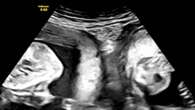 Woman with rare double uterus gives birth to twins