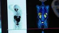 Drug trial offers prostate cancer patients new hope