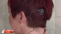 The implant giving hope to Aussies with epilepsy