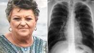 This lung disease affects one in 13 Aussies over 40, but only half know they have it