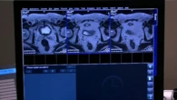 More Australian men to be tested for prostate cancer in world-first reforms