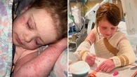 'Tearing her skin apart': Sydney family among thousands priced out of life-changing medication