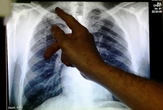 SA encouraged to prepare early for new TB vaccine rollout