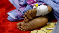 Somalia faces diphtheria surge amid vaccine shortages and aid cuts