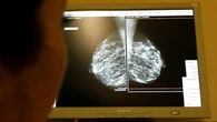 Wits researchers discover unique breast cancer genes in black women