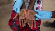 Screening for Mpox under way at Lebombo Border