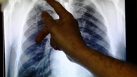 FS ramps up TB campaign, targets 22,000 defaulters and mine workers