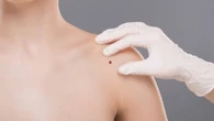 La mappatura dei nei non è sparita dai Lea, 'è nella visita dermatologica'