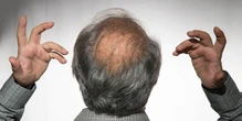 Impatto psicosociale della calvizie: Il potenziale del trapianto di capelli per Migliorare la Vita