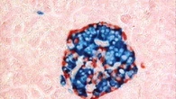 Prime isole del pancreas umane stampate in 3D, futura arma anti-diabete