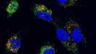 Per i tumori del cervello oltre 100 identikit molecolari