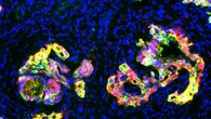 Dalla luce la tecnica che distingue le cellule tumorali da quelle sane