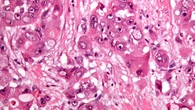 Tumore del fegato, le cellule si rimodellano per resistere ai farmaci
