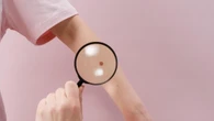 Melanoma, bastano 5 scottature a 15-20 anni per aumentare il rischio dell'80%