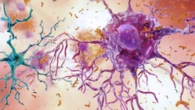 Alzheimer, scoperta una variante genetica alleata del cervello