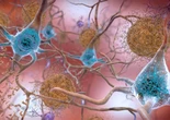 E' vero che l'Alzheimer si può diagnosticare precocemente?