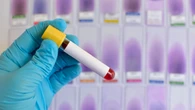 Iss, in arrivo un piano nazionale contro epatiti e hiv