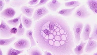 Cellule che si muovono in gruppo punto debole del tumore al seno