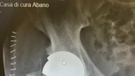 Nuove protesi d'anca con tecnica mininvasiva per la prima volta in Italia