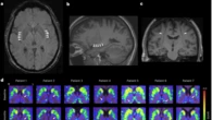 Parkinson, trapianto di staminali nel cervello di 8 pazienti