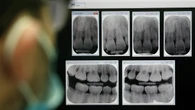 Estrazioni controllate opzione per denti disallineati