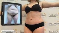 Addominoplastica Laser: Nuova Frontiera nella Chirurgia Estetica