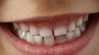 L'inquinamento da metalli è dannoso per i bambini, lo dicono i denti da latte