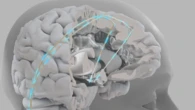 Chip impiantabili più vicini, aiutano a parlare e a camminare VIDEO