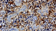 Allo studio un vaccino personalizzato contro il glioblastoma