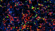 Nanoparticelle efficaci contro il tumore della prostata, uccidono le cellule
