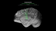 Parkinson, ultrasuoni in un caschetto cancellano i tremori in modo non invasivo