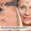 Deep fractional laser assisted facelift: Rivoluzione nel ringiovanimento chirurgico