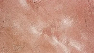 Stevens Johnson Syndrome Bisa Dipicu Obat, Ketahui Ciri dan Cara Penanganannya